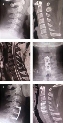 Osteophyte formation causes neurological symptoms after anterior cervical discectomy and fusion (ACDF): A case report